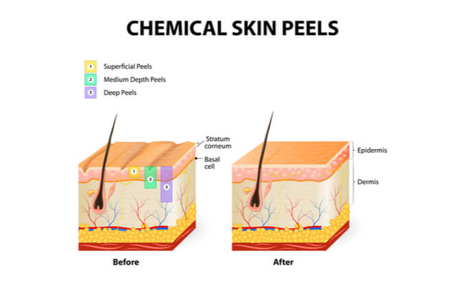Comparaison de seffets sur la peau avant et après un peeling chimique